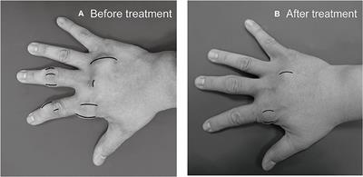 Limited Knee-Joint Range of Motion in Patients With Tophaceous Gout Improved With Medical Treatment: A 18-Months Follow Up